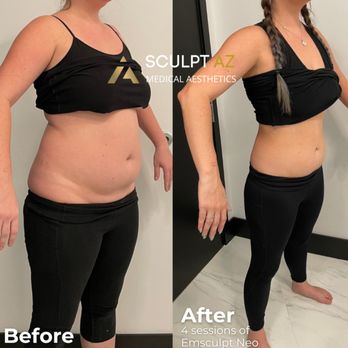 Sculpt AZ - Real results with Emsculpt Neo! - Medical Spas Near Me - Phoenix, Arizona
