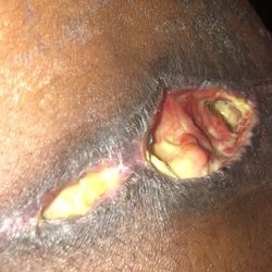 Prestige Plastic Surgery - After hospitalization