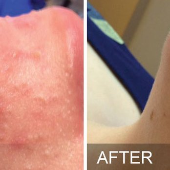 Simply Flawless Skin - Oily acne skin condition - Medical Spas Near Me - Oakland , California Simply Flawless Skin - Oily acne skin condition - Medical Spas Near Me - Oakland , California