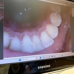 Monika Bhatia, DDS - Pre-cleaning
