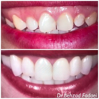 LA Dental - Veneers - Cosmetic Dentists Near Me - Van Nuys, California LA Dental - Veneers - Cosmetic Dentists Near Me - Van Nuys, California