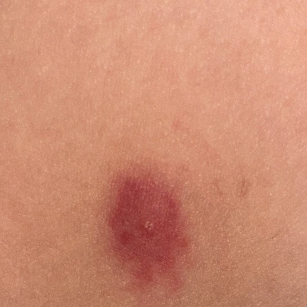 Bug bite while sleeping