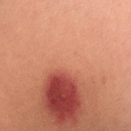Bug bite while sleeping