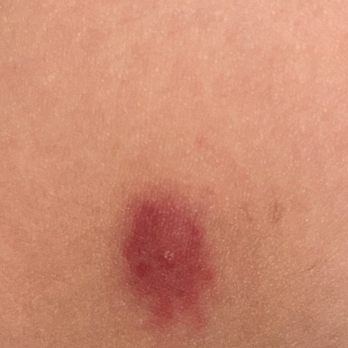 Bulwark Exterminating - Bug bite while sleeping - Pest Control Near Me - Las Vegas, Nevada