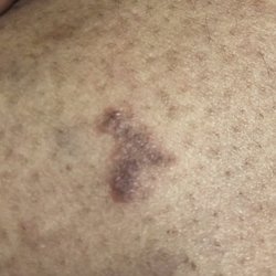 Ma Acupuncture Center - Before picture of the Basal Cell Sarcoma with bruising.
