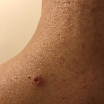 Axis Chiropractic, integrated care - This is the burn on the back of my neck after the electrode muscle relaxer therapy - Chiropractors Near Me - San Francisco, California Axis Chiropractic, integrated care - This is the burn on the back of my neck after the electrode muscle relaxer therapy - Chiropractors Near Me - San Francisco, California