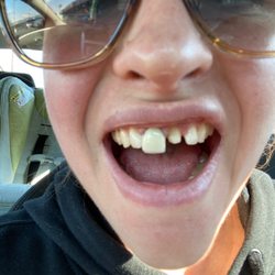 Illinois Dental Centers - Crown fell out and they don't even look natural!