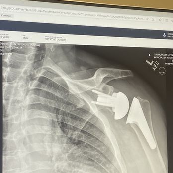 Green Oaks Physical Therapy - Arthroplasty Reverse Shoulder replacement! Physical Therapy treatmen.t - Physical Therapy Near Me - Waxahachie, Texas Green Oaks Physical Therapy - Arthroplasty Reverse Shoulder replacement! Physical Therapy treatmen.t - Physical Therapy Near Me - Waxahachie, Texas