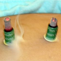 Liying Acupuncture Healing Service - Moxa