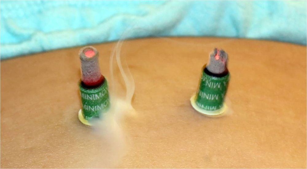 LIYING ACUPUNCTURE HEALING SERVICE 20 Photos 8975 Guilford Rd