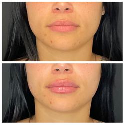SkinLab Laser Aesthetics & Wellness - Lip filler before and after