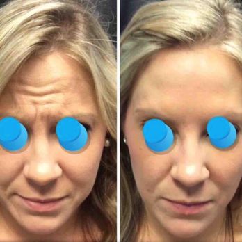 MidState Skin Institute - Botox forehead - Dermatologists Near Me - Ocala, Florida