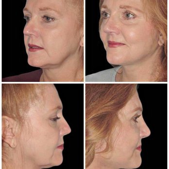 Robert Guida, MD - Rhinoplasty with Full Face and Neck Lift!! - Cosmetic Surgeons Near Me - New York, New York Robert Guida, MD - Rhinoplasty with Full Face and Neck Lift!! - Cosmetic Surgeons Near Me - New York, New York