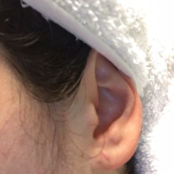 Christopher C Chang, M.D - Congressional Plastic Surgery - One week after my procedure. Stitches are out. Now to let the earlobe heal on its own a little more. - Cosmetic Surgeons Near Me - Chevy Chase, Maryland Christopher C Chang, M.D - Congressional Plastic Surgery - One week after my procedure. Stitches are out. Now to let the earlobe heal on its own a little more. - Cosmetic Surgeons Near Me - Chevy Chase, Maryland