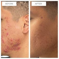 Med Aesthetics Miami in Aventura - Acne Treatment