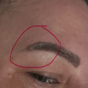 Rouge Medical Spa - Next day, full blister ON THE BROW. The ink will be affected my artist told me, due to damage from the laser - Medical Spas Near Me - Sacramento, California Rouge Medical Spa - Next day, full blister ON THE BROW. The ink will be affected my artist told me, due to damage from the laser - Medical Spas Near Me - Sacramento, California