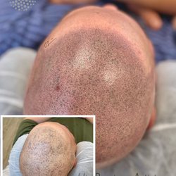 Scalp MicroPigmentation of California