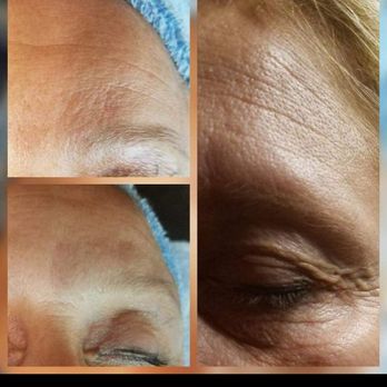 Revive Aesthetics - Before and After pictures of Microchanneling - Skin Care Near Me - Green Bay, Wisconsin Revive Aesthetics - Before and After pictures of Microchanneling - Skin Care Near Me - Green Bay, Wisconsin