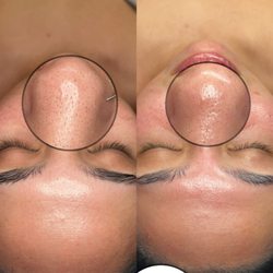 Helen Joyce Beauty - Extractions are included in every facial