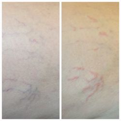 Mountain Medical Spa and Laser Center - Spider Vein Removal Treatments. Before and immediately after