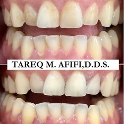 Chino Valley Smile Center - Staining Removal -  Before and After