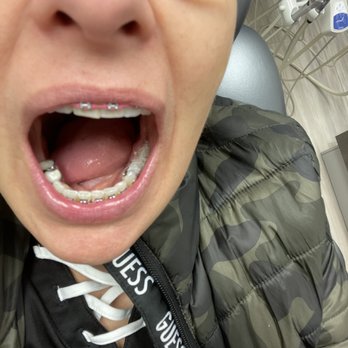 Ivory Dental Manteca - Infection gone. Dr. Gill cleaned it out and I'm eating mashed potatoes and soups. - Cosmetic Dentists Near Me - Manteca, California