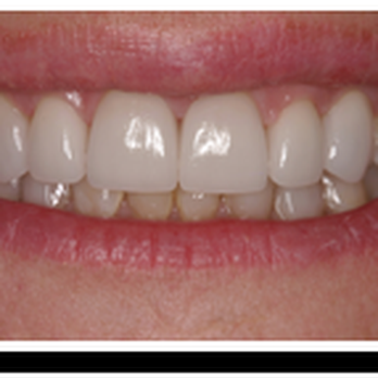 Behner Family Dentistry - After Whitening and Cleaning Treatment - General Dentistry Near Me - Altamonte Springs, Florida Behner Family Dentistry - After Whitening and Cleaning Treatment - General Dentistry Near Me - Altamonte Springs, Florida