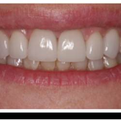 Behner Family Dentistry - After Whitening and Cleaning Treatment