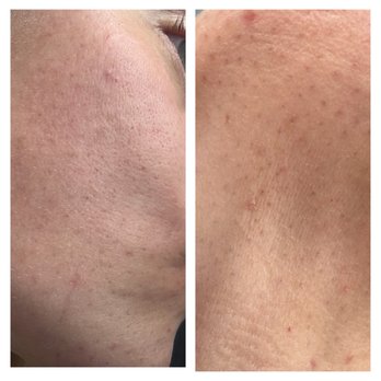 The Den Salon - Permanent dark spots and picks that won't go away after fibroblast treatment. - Blow Dry/Out Services Near Me - Chino Hills, California The Den Salon - Permanent dark spots and picks that won't go away after fibroblast treatment. - Blow Dry/Out Services Near Me - Chino Hills, California