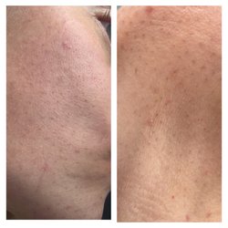 Permanent dark spots and picks that won't go away after fibroblast treatment.