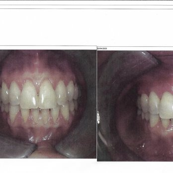 Tracy G Golden, D M D - before and after gum graft - Periodontists Near Me - Los Angeles, California Tracy G Golden, D M D - before and after gum graft - Periodontists Near Me - Los Angeles, California