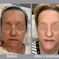 Aesthetix Plus Medical Spa - Laser PicoSure and Potenza microneediling