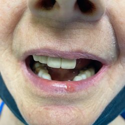 Carondelet Park Dental Care - Before dental implants