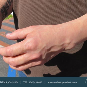Aesthetic Prosthetics - Prosthetics Near Me - Pasadena, California Aesthetic Prosthetics - Prosthetics Near Me - Pasadena, California