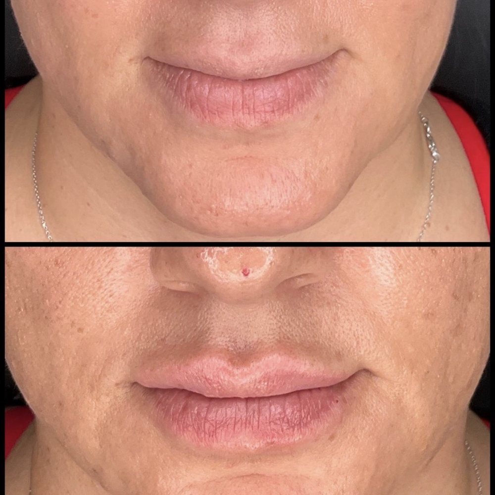 Paradise Medspa & Wellness - Top is before and bottom is after - Medical Spas Near Me - Phoenix, Arizona Paradise Medspa & Wellness - Top is before and bottom is after - Medical Spas Near Me - Phoenix, Arizona