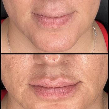 Paradise Medspa & Wellness - Top is before and bottom is after - Medical Spas Near Me - Phoenix, Arizona Paradise Medspa & Wellness - Top is before and bottom is after - Medical Spas Near Me - Phoenix, Arizona