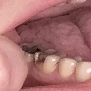 Omni Dental Group - My tooth after they finished my procedure they put in a side filling and it snapped a week later and crumbled and they don't care - General Dentistry Near Me - Austin, Texas
