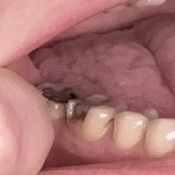 Omni Dental Group - My tooth after they finished my procedure they put in a side filling and it snapped a week later and crumbled and they don't care