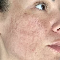 Mount Pleasant Dermatology - Hyperpigmentation following procedure