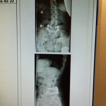 Brian Su, MD - He designed a cage to hold the L3-L6 in place & screwed in the space where the disc used to be! Science, Art & the touch of God! - Orthopedists Near Me - Larkspur, California