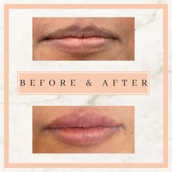 Belle Ame Med Spa & Boutique - 1CC of Lip Filler. Before/Immediately after