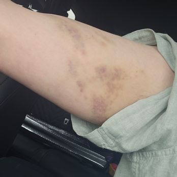 Silk Exotic Platinum - Bruises left by staff - Bars Near Me - Milwaukee, Wisconsin