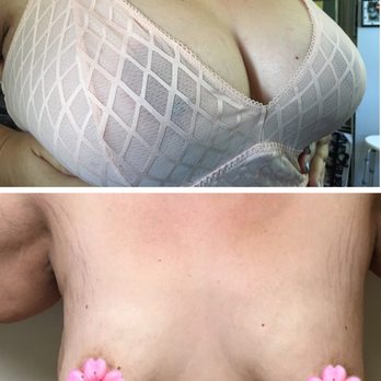 Dr. Alejandro Gálvez - Amazing job on my tatas! - Cosmetic Surgeons Near Me - Tijuana, BCN