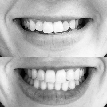 Bay View Dental - The day I walked in to get my first Invisalign tray vs. the day I finished treatment - General Dentistry Near Me - San Diego, California
