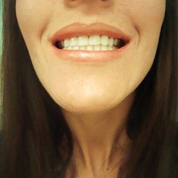 Park Circle Dental - After 3 crowns & 3 veneers