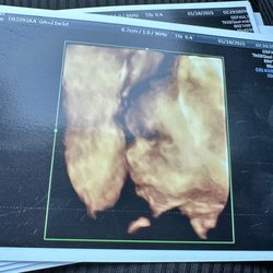 Mommy and Me 3D 4D Ultrasound - My sweet boy