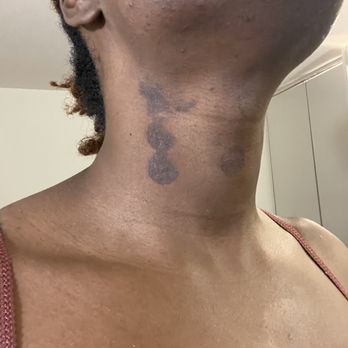 Ideal Image Vancouver - Spent a lot of money to be consistently burn.This is extremely disheartening.This happened in Rochester,and Vancouver. - Laser Hair Removal Near Me - Vancouver, Washington