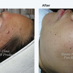 Renee Katherine Acne Clinic
