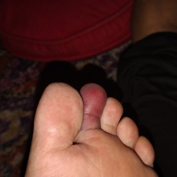 CVS Pharmacy - This is my broken toe - Drugstores Near Me - San Carlos, California
