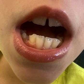 Brea Dental Group - Chipped tooth - Oral Surgeons Near Me - Brea, California Brea Dental Group - Chipped tooth - Oral Surgeons Near Me - Brea, California
